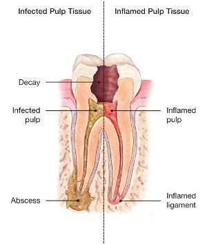 Dental abscess explained by Dr. Rahim Karmali, Lowry Endodontics, Denver